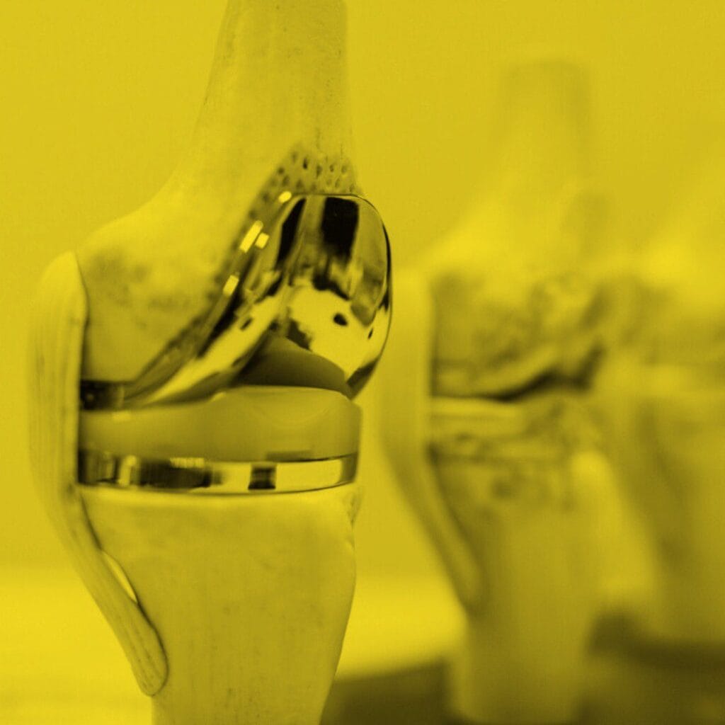 Adjusting to Life Post-Surgery: Understanding Potential Limitations After Knee Replacement