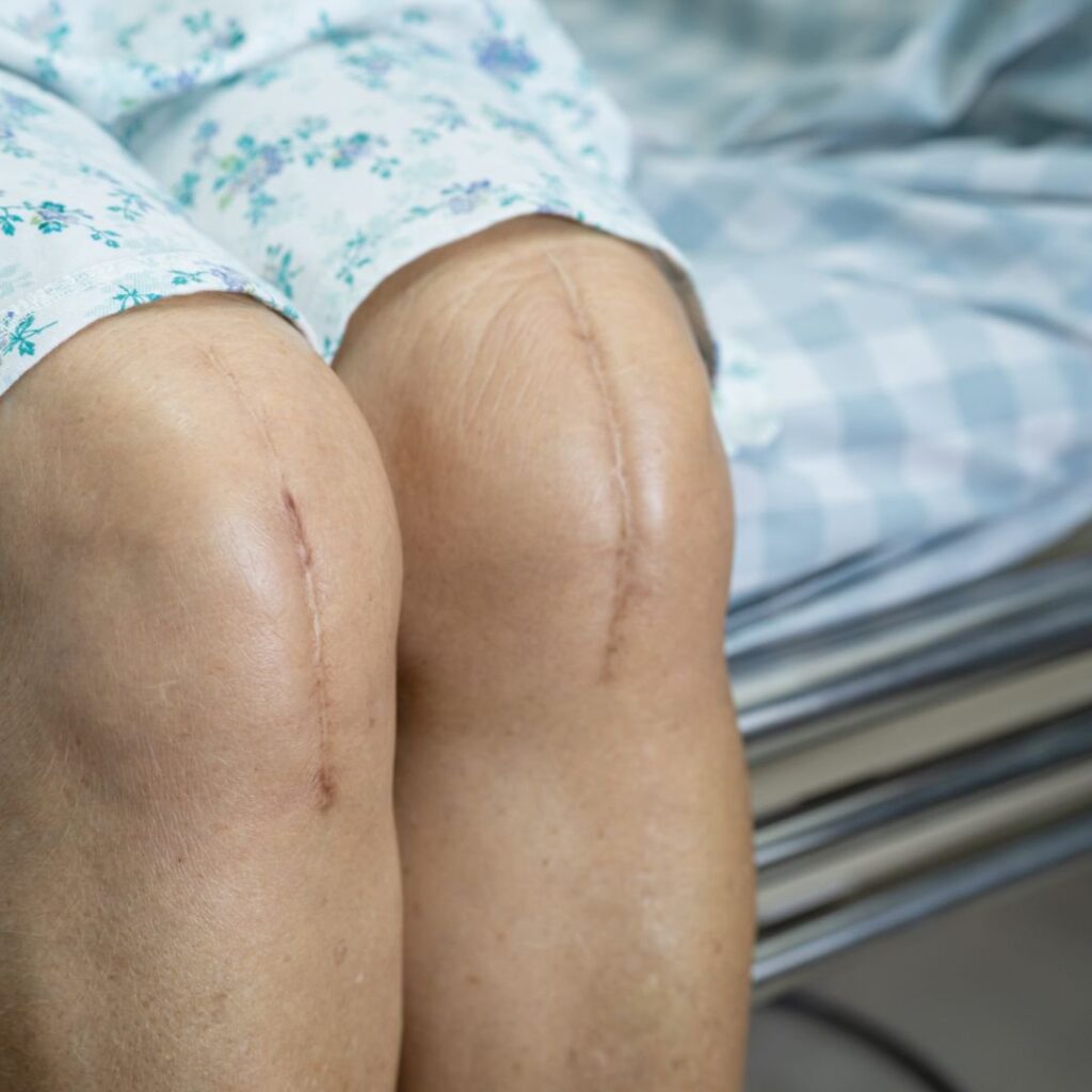 Stuck in Knee Replacement Recovery Limbo? This Might Be The Reason