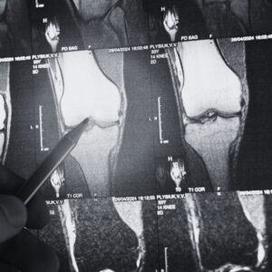 The MISHA Knee System: Implantable Shock Absorber for Your Knees cover