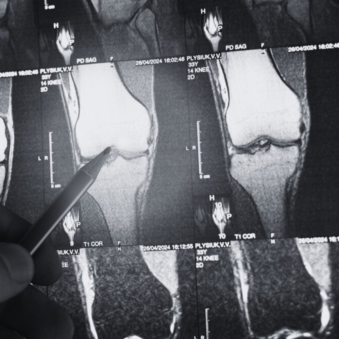 The MISHA Knee System: Implantable Shock Absorber for Your Knees cover