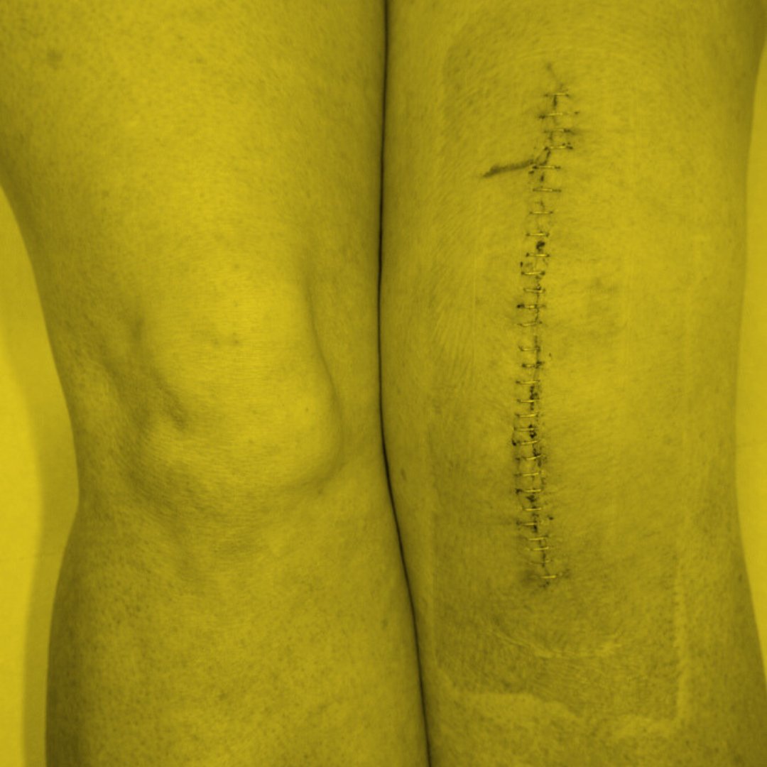 Pain after knee replacement surgery