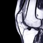 What Happens to the ACL After Total Knee Replacement Surgery?