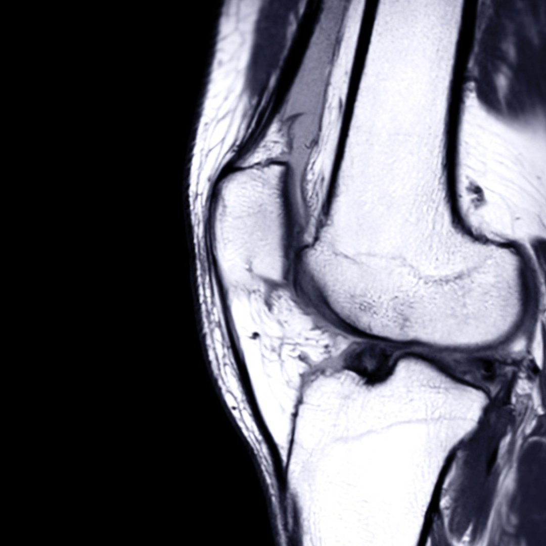 ACL after knee replacement