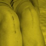 What’s Missing in Many Knee Replacement Recovery Plans?