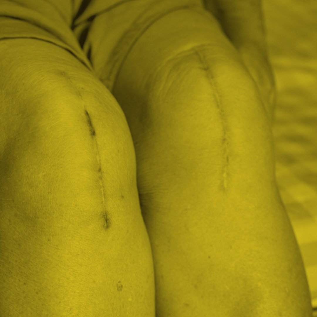 Knee replacement surgery rehab